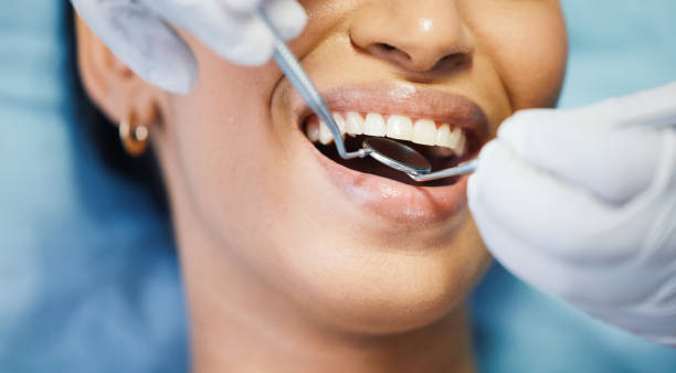Best Emergency Wisdom Teeth Removal in Bridgeport, WA